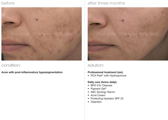 Pca Peels Before And After